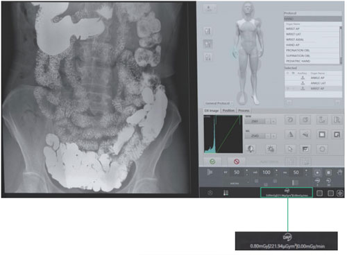 Dynamic FPD Digital Radiography & Fluoroscopy System PLD9600 Series image 21